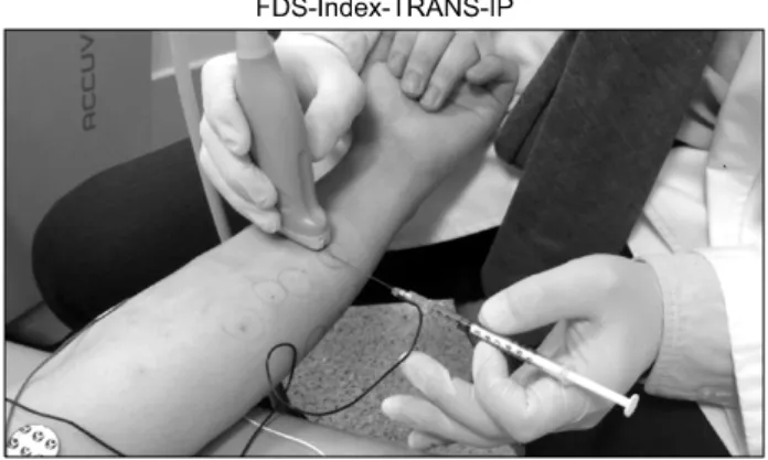 Fig.  5.  In-plane  technique  with  transverse  view  of  the  flexor  dig- dig-itorum  sublimis  muscle  for  the  index  finger.