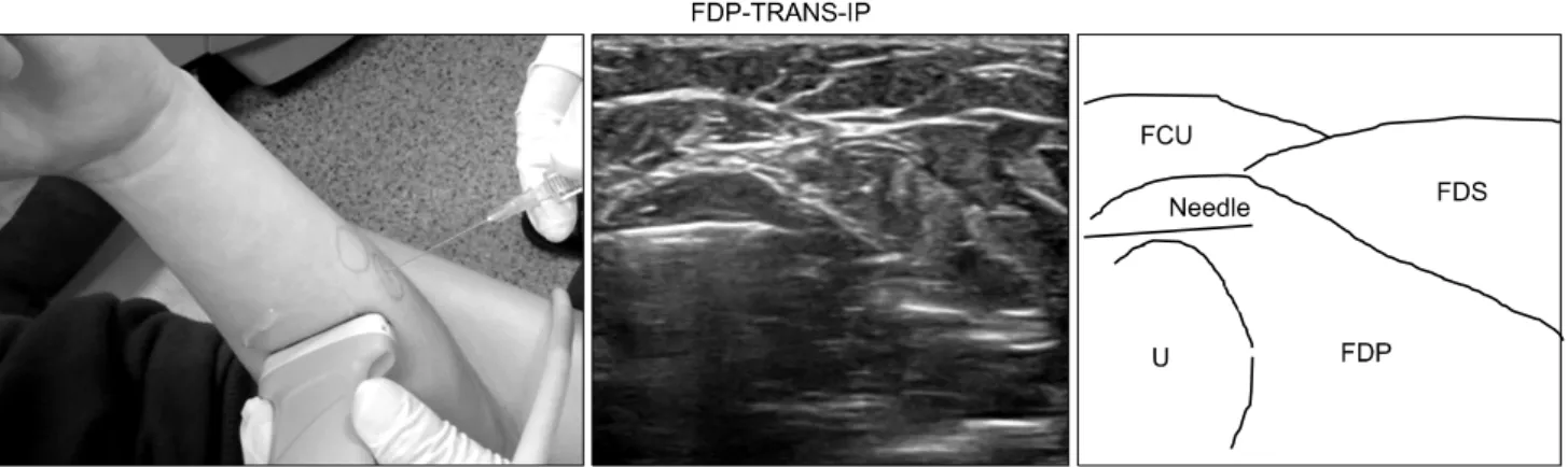 Fig.  6.  In-plane  technique  with  transverse  view  of  the  flexor  digitorum  profundus  muscle