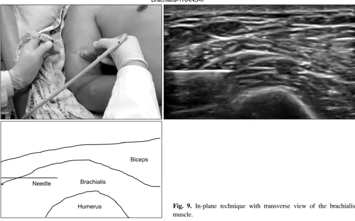 Fig.  9.  In-plane  technique  with  transverse  view  of  the  brachialis  muscle.