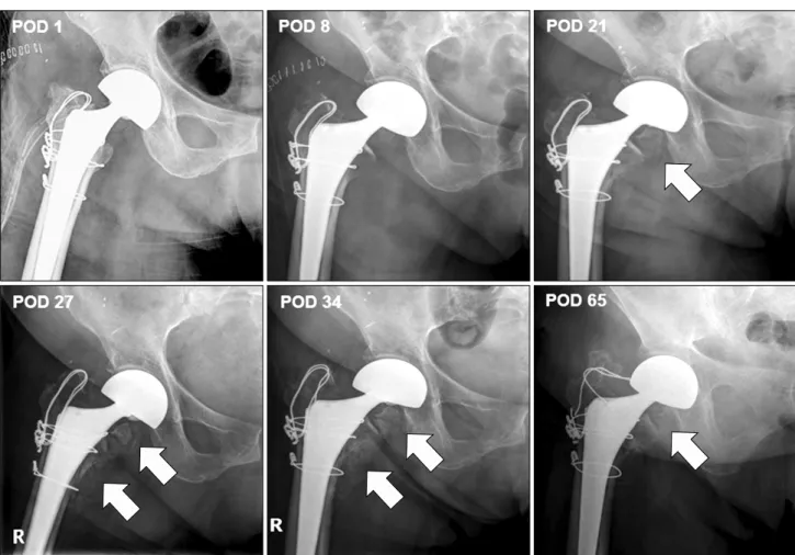 Fig.  2.  Serial  hip  x-ray  shows  a  maturation  and  disappearance  of  heterotopic  ossification  around  the  right  hip  joint  after  proper  manage- manage-ment  with  the  clinical  pathway.