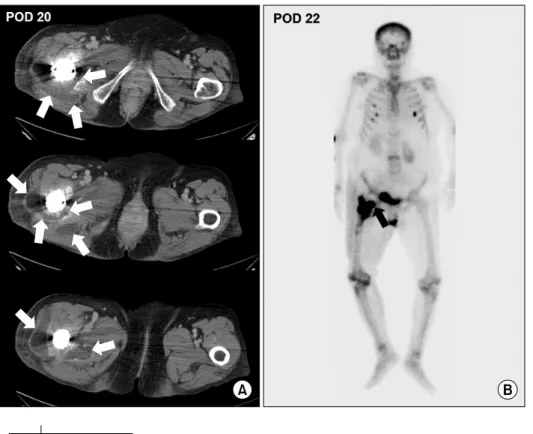 Fig.  3.  Serum  ALP  levels  increased  with  pain  and  swelling  initially.  Then  serum  CRP,  CK  followed  by  the  ALP  at  the  time  of  confirmation  of  heterotopic  ossification  radiographically