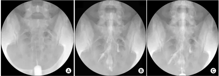 Fig.  2.  (A)  Fluoroscopy  guided  caudal  epidural  injection  using  a  25-gauge  short  needle  (PA  view)