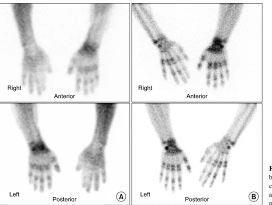 Fig.  1.  Three-Phase  bone  scan  of  both  upper  extremities  shows   in-creased  radio-uptake  in  left  wrist  and  finger  joints