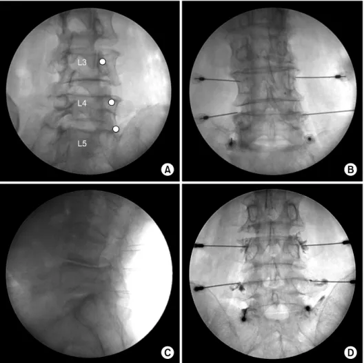 Fig.  1.  (A)  Oblique  view  of  the  lumbar  spine  with  the  target  points  marked  with  white  dots  for  blocks  of  the  L3,  L4  medial  branches  and  the  L5  dorsal  ramus
