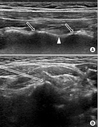 Fig.  1.  Ultrasound-guided  cervical  medial  bundle  branch  block  or  facet  block