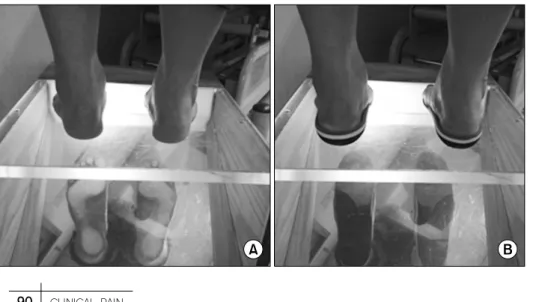 Fig.  1.  Subtle  cavus  foot,  heel  with  varus  position  (A).  Correction   ach-ieved  with  custom-made  orthoses  (B).여 경미한 요족 변형이 있는 환자에서 정상인에 비해 한발서기 자세 시 자세균형조절기능의 저하여부를 알아보고 맞춤형 안창을 착용하여 이를 감소시킬 수 있는지를 알아보고자 하였다.연구대상과  방법1
