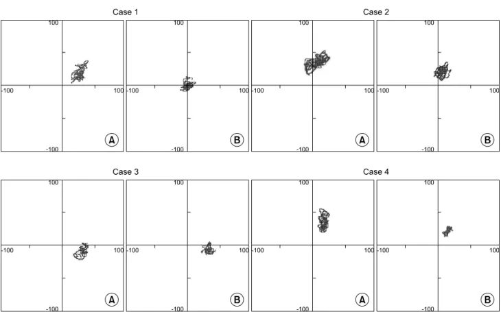 Fig.  3.  Center-of-pressure  excursion  in  subtle  cavus  foot,  barefoot  condition  (A),  Wearing  orthoses  (B)