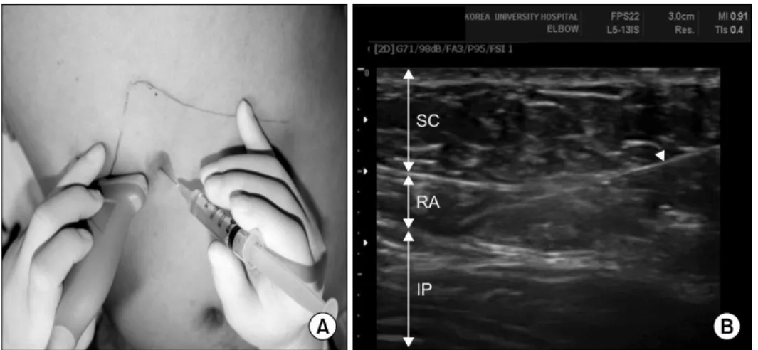 Fig.  1.  (A)  Ultrasound-guided  ab- ab-dominal  muscle  injection  is   per-formed  with  clean  technique