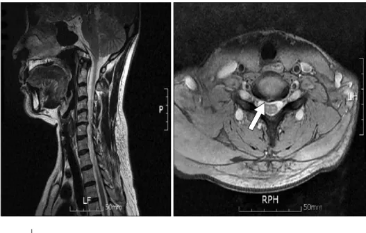 Fig.  1.  Initial  T2W  MR  image  show  degenerative  change  and  mild  central  disk  protrusion  in  C5-6  (arrow).번 추간판의 변성과 중심부 돌출로 인한 척추관 협착,  경추부 5-6번 우측 추간공 협착증 소견이 보였다(Fig
