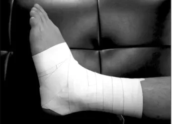 Fig.  1.  Ankle  taping  with  basket  weave  technique  using  cotton  tapes. 2  시즌 동안 테이핑을 한 집단에서는 6.5건/1,000  경기의  발목 염좌 발생률을 보였고,  대조 집단에서는 30.4건/1,000 경기의 발생률을 보였다