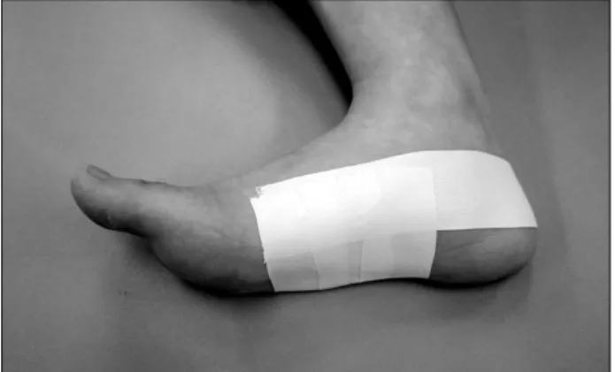 Fig.  3.    Low-Dye  taping  for  the  antipronation  of  foot.실제로 그렇다면 운동 선수들은 실제와 달리 테이핑을 사용하지 않으려 할 것이다
