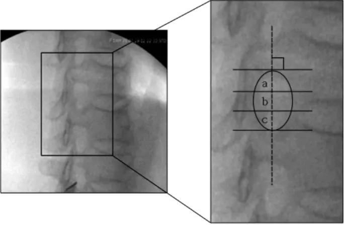 Fig.  1.  Needle  tip  locations  in  the  neural  foramen  are  categorized  on  the  oblique  view,  where  the  foramen  is  divided  into  three   ver-tical  regions-upper  (a),  middle  (b),  and  lower  (c)  by  transecting  the  major  axis  of  the