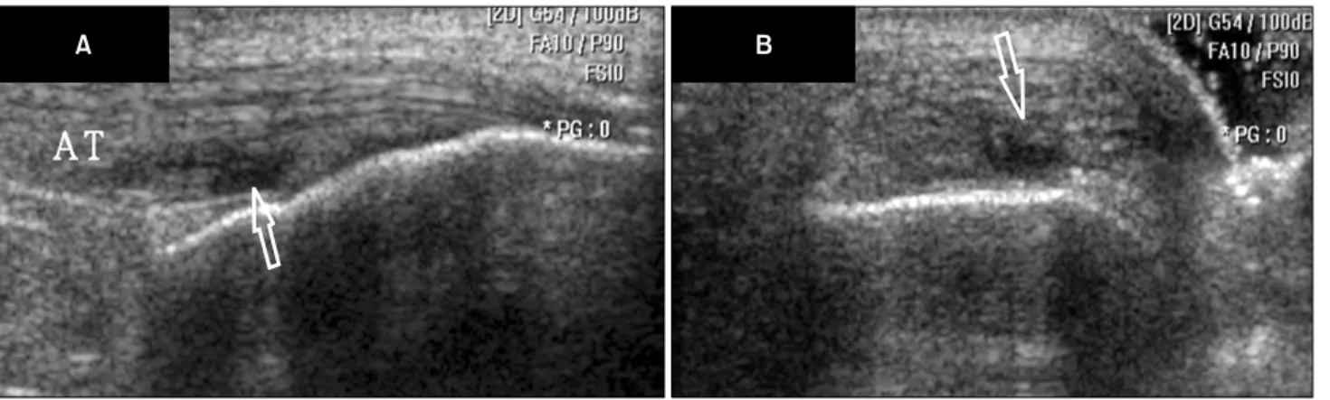 Fig.  3.  Partial  rupture  of  the  Achilles  tendon.  (A)  Longitudinal  and  (B)  transverse  12-6  MHz  US  images  demonstrate  a  spectrum  of  a  appearences  of  partial-thickness  tears  of  the  Achilles  tendon  (AT)