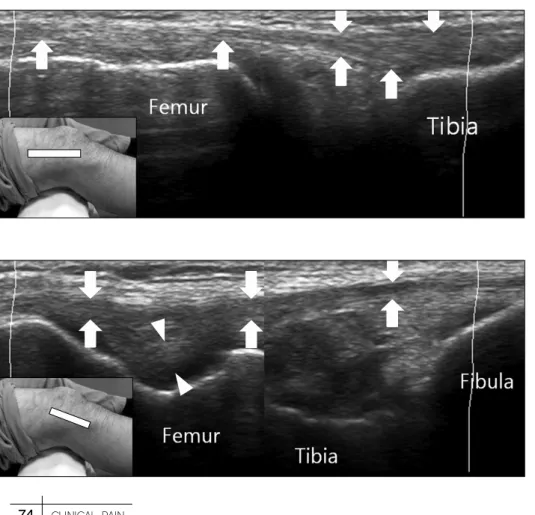 Fig.  10.  The  iliotibial  band  inserts  on  the  Gerdy’s  tubercle  of  the  tibia