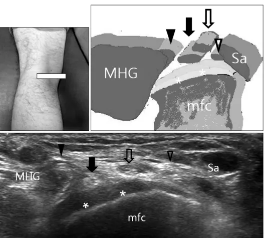 Fig.  12.  Medial  tendons.  Asterisks: 