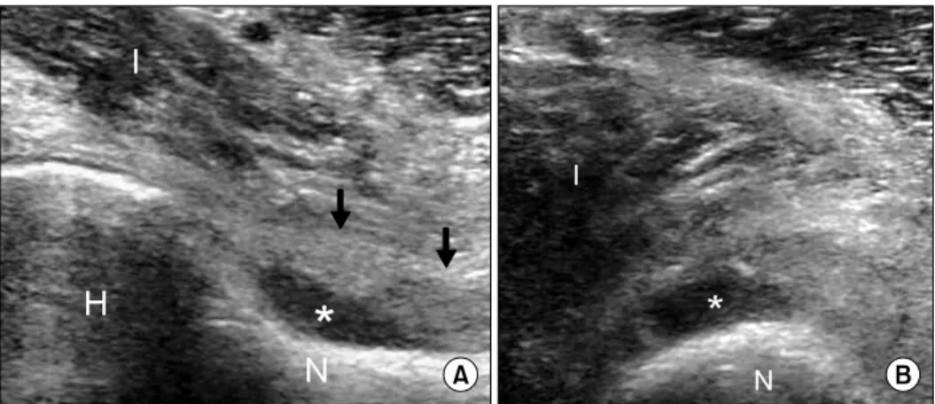 Fig.  1.  Hip  joint  effusion.  Longitu- Longitu-dinal  (A)  and  transverse  (B)   ultra-sonographic  images  of  the  anterior  hip  demonstrate  the  hyperechoic  joint  capsule  (arrows),  displaced  from  the  echogenic  interface  of  the  femoral  