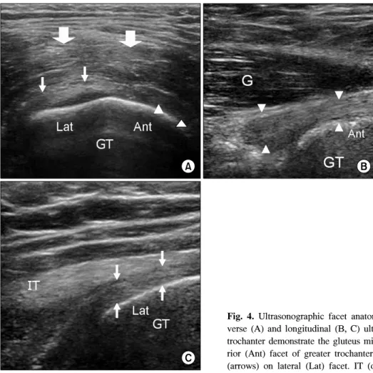 Fig.  5.  Gluteus  medius  tendinosis. 