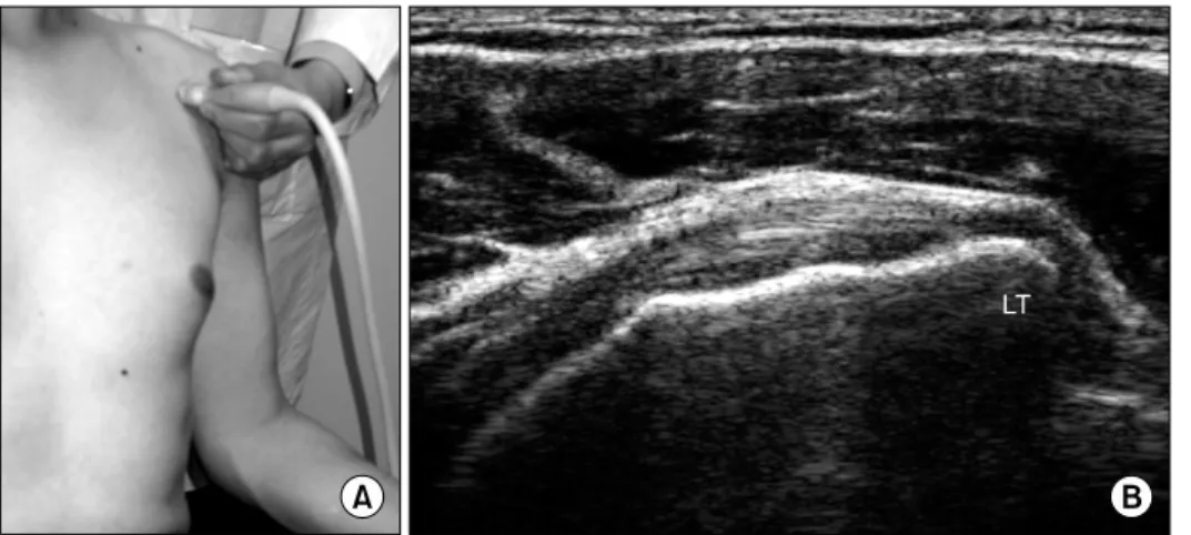 Fig.  3.  Longitudinal  biceps  view.  (A)  Longitudinal  imaging  of  the  biceps  tendon