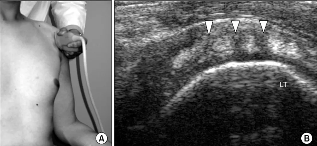 Fig.  6.  Coronal  transverse  view  of  acromioclavicular  joint.  (A)  Coronal  imaging  of  acromiclavicular  joint