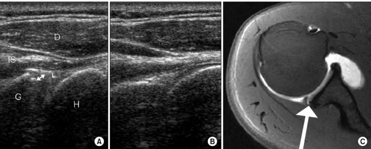 Fig.  17.  Torn  posterior  labrum  of  a  42  year  old  male  with  a  SLAP  lesion  in  his  right  painful  shoulder  (A)