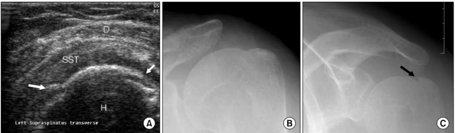 Fig.  19.  A  66-year-old  woman  with  greater  tuberosity  fracture.  Transverse  sonogram  (A)  shows  mildly  displaced  fracture  of  the  greater  tuberosity  (arrows)  that  was  not  revealed  on  routine  plain  X  rays  (B)  but  the  caudal  til
