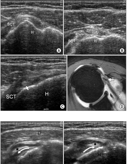 Fig.  3.  No  tendinous  structure  is  seen  in  the  bicipital  groove  of  a  55  year  old  female  (A)