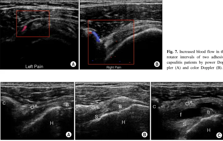 Fig.  7.  Increased  blood  flow  in  the  rotator  intervals  of  two  adhesive  capsulitis  patients  by  power   Dop-pler  (A)  and  color  DopDop-pler  (B).