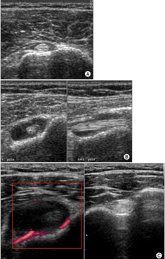 Fig.  9.  Ultrasonographic  findings  of  bicipital  bursae  of  normal  (A),  adhesive  capsulitis  (B)  and  a  side  by  side  comparison  of  a  male   rheu-matoid  arthritis  patient  (C)   show-ing  increased  blood  flow  by  Power  Doppler  techniq