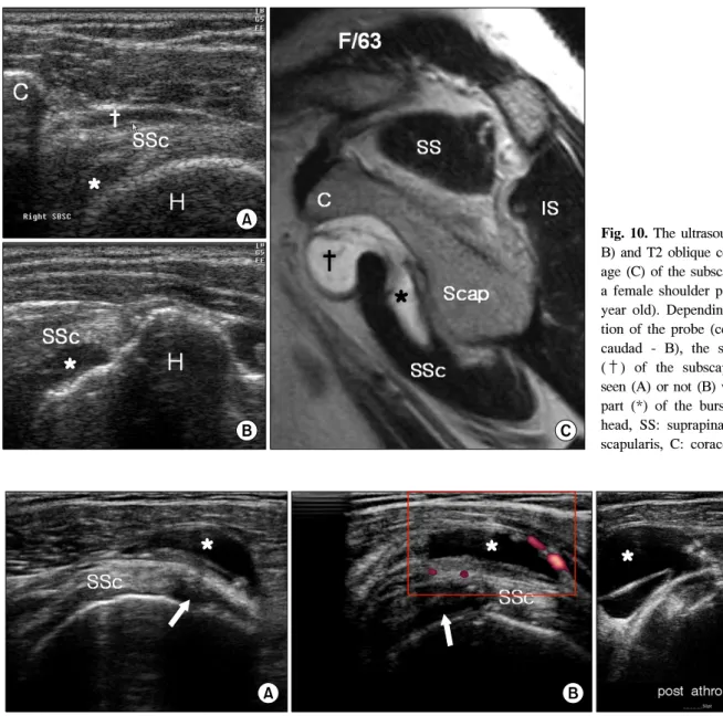 Fig.  10.  The  ultrasound  images  (A,  B)  and  T2  oblique  coronal  MR   im-age  (C)  of  the  subscapular  bursa  of  a  female  shoulder  pain  patient  (63  year  old)