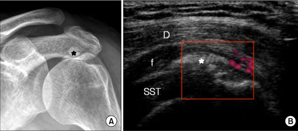 Fig.  16.  Fluid  collection  (f)  in  the  subacromial-subdeltoid  bursa  is  shown  in  longitudinal  (A)  and  transverse  (B)  views