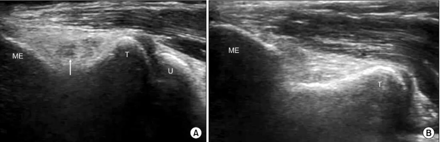 Fig.  7.  Torn  anterior  band  of  the  ulnar  collateral  ligament.  Longitudinal  (A)  ultrasound  image  demonstrating  disruption  of  normal  fibers,  indicating  a  partial-thickness  tear