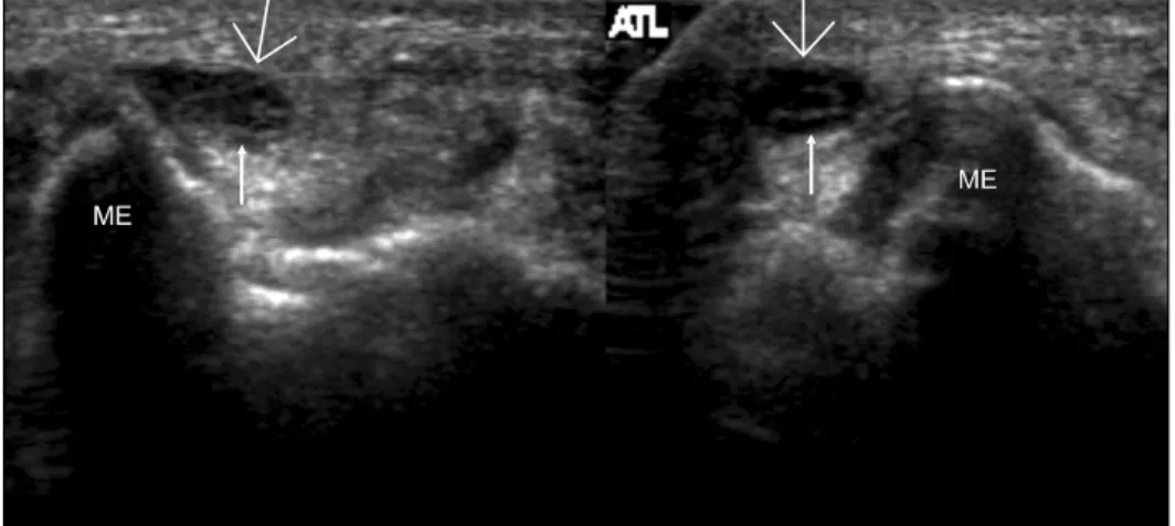 Fig.  10.  Retrocondylar  compression  syndrome.  Longitudinal  ul- ul-trasound  image  at  the  medial  epicondyle  (ME)  demonstrating  the  ulnar  nerve  (arrow),  which  shows  diffuse  swelling  from   prox-imal  end  of  medial  epicondyle  (PME)  to