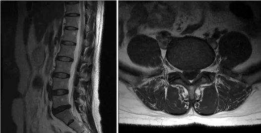 Fig.  3.  The  post  discographic  L-spine  CT  (L4-L5  level):  concen- concen-tric  contrast  filling  along  the  outer  margin  of  the  disk.