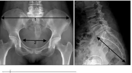 Fig.  1.  The  measured  parameters  in  pelvic  x-ray.  (1)  false  pelvis  that  is  between  bilateral  anterior  superior  iliac  spine,  (2)  true  pelvis  that  is  between  bilateral  ischial  spine,  (3)  height  of  sacrococcyx.입되지 않은 상태에서 천골미골인대를
