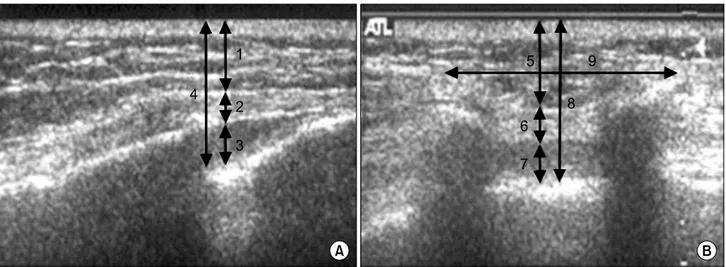 Fig.  2.  (A)  The  measured  parameters  using  ultrasound  in  longuitudinal  section
