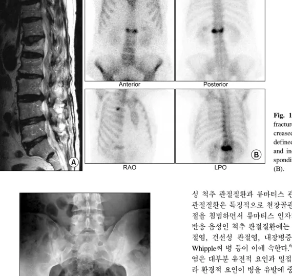 Fig.  1.  Osteoporotic  compression  fracture  of  the  vertebrae  shows   de-creased  vertebral  height  with  well-  defined  margin  in  MR  image  (A)  and  increased  uptake  at  the   corre-sponding  vertebrae  in  bone  scan  (B).