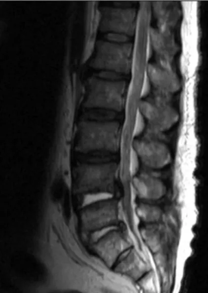 Fig.  4.  Osteitis  condensans  ilii  is  increased  density  in  the  ilium. 