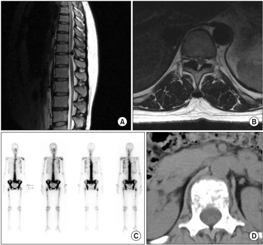 Fig.  6.  (A)  and  (B)  are  osteobla- osteobla-stoma.  Posterior  structures  of  the  spine,  transverse  process,  pedicle  or  facet  joint,  were  more   fre-quently  involved  in  the  benign   spi-nal  tumors