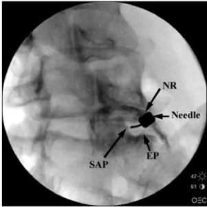Fig.  2.  Safe  triangle  for  needle  insertion.  NR:  nerve  root,  SAP: 