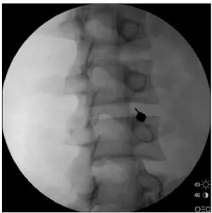 Fig.  4.  The  ideal  position  of  needle  when  the  needle  contacts  the  disc  (arrow)  is  on  the  line  between  midpoint  of  pedicles