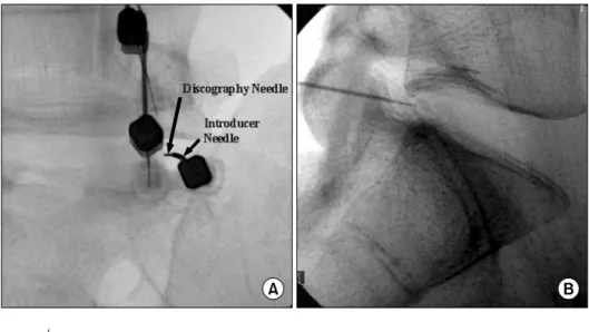Fig.  7.  (A)  When  the  inner  needle  emerges,  the  guide  needle  is   simul-taneously  retracted  slightly