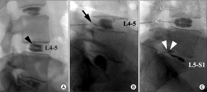 Fig.  8.  (A)  Normal  spreading  pattern  of  contrast  medium  in  the  disc.  (B)  Contrast  medium  escapes  into  the  epidural  spaces  through  a  torn  annulus