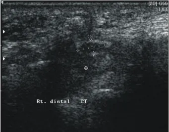 Fig.  2.  Transverse  ultrasound  of  median  nerve.  The  transverse  diameter  and  anteroposterior  diameter  were  7.4  mm  and  2.9  mm