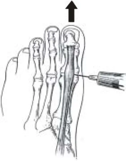 Fig.  2.  Subtalar  joint  injection  technique:  needle  insertion  below  sustentaculum  tali.