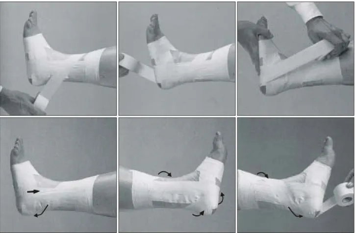 Fig.  4.  Procedure  of  taping  for  rehabilitation  stage  of  lateral  ankle  sprain