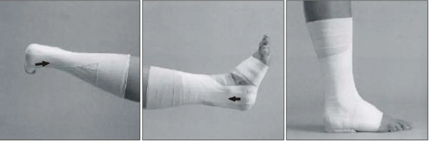 Fig.  6.  Procedure  of  taping  for  peroneus  longus  tendon  injury. 3)