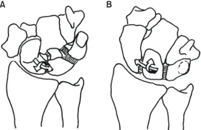 Fig.  4.  Schematic  representation  of  the  direction  of  rotation  of  the  proximal  carpal  row  during  radial  (A)  and  ulnar  (B)  deviation  of  the  wrist.
