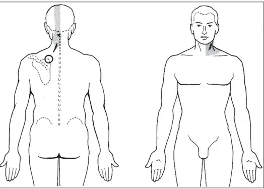 Fig.  4.  Pain  site  of  C3  radiculopathy.