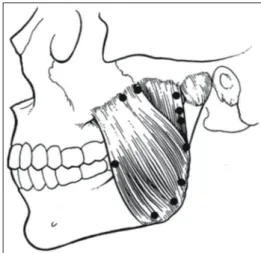Fig.  8.  Needling  point  for  temporomandibular  joint  dysfunction.