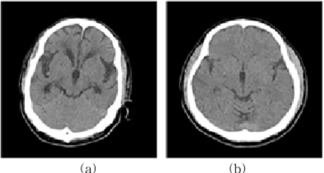 Fig. 1 shows an example of CT images from the two groups.
